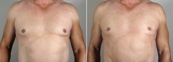 Male Abdominoplasty Patient 6