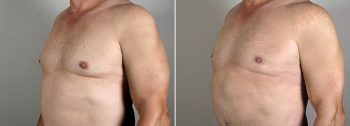 Male Abdominoplasty Patient 6
