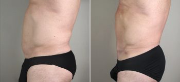 Male Abdominoplasty Patient 6