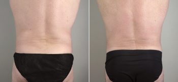 Male Abdominoplasty Patient 6