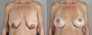 Breast Lift with Implants Patient 20