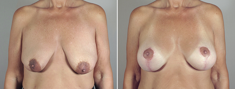 Breast Lift with Implants Patient 20