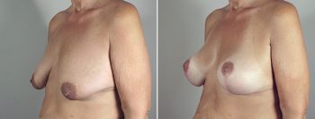 Breast Lift with Implants Patient 20