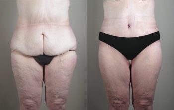 Thigh & Buttocks Lifting Surgery Patient 13