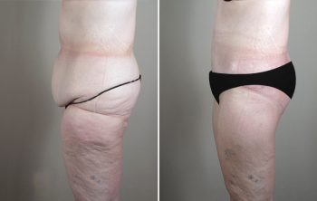 Thigh & Buttocks Lifting Surgery Patient 13