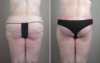 Thigh & Buttocks Lifting Surgery Patient 13