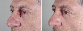 Skin Cancer Treatment Patient 27