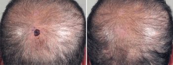 Skin Cancer Treatment Patient 27