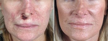 Skin Cancer Treatment Patient 28