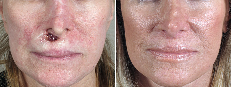 Skin Cancer Treatment Patient 28