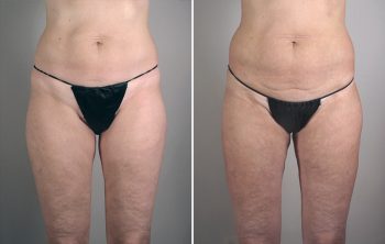 Thigh & Buttocks Lifting Surgery Patient 10