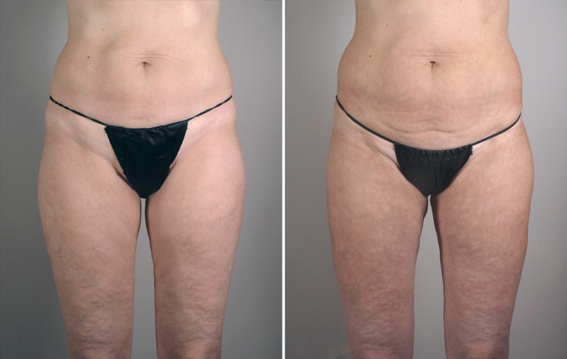 Thigh & Buttocks Lifting Surgery Patient 10