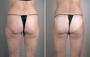 Thigh & Buttocks Lifting Surgery Patient 10