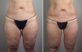 Thigh Lifting Surgery Patient 9