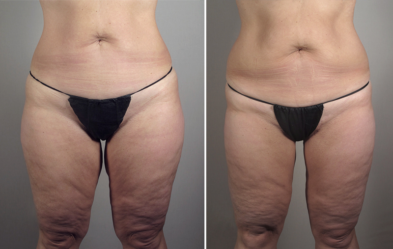 Thigh Lifting Surgery Patient 9