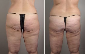 Thigh Lifting Surgery Patient 9
