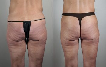 Thigh Lifting Surgery Patient 11