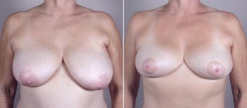 Breast Lift (Vertical Mastopexy Only) Patient 9