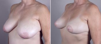 Breast Lift (Vertical Mastopexy Only) Patient 9