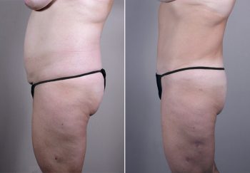 Breast Lift (Vertical Mastopexy Only) Patient 9