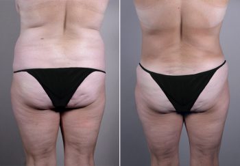 Breast Lift (Vertical Mastopexy Only) Patient 9