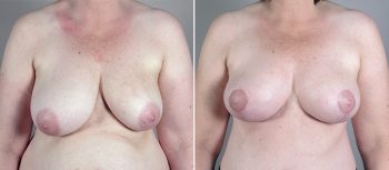 Mommy Makeover Patient 23