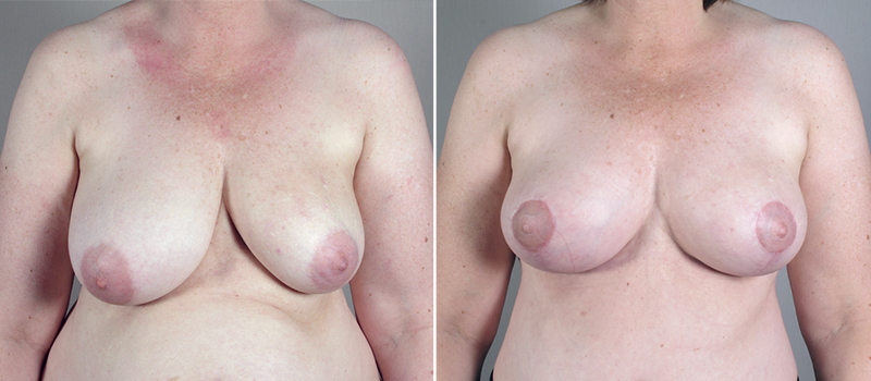 Mommy Makeover Patient 23