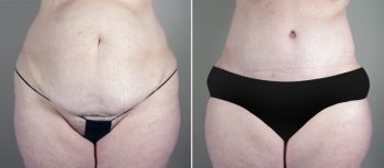 Mommy Makeover Patient 23