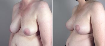 Mommy Makeover Patient 23