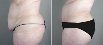 Mommy Makeover Patient 23