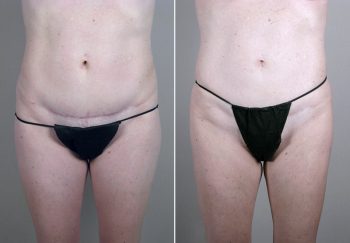 Mommy Makeover Patient 22