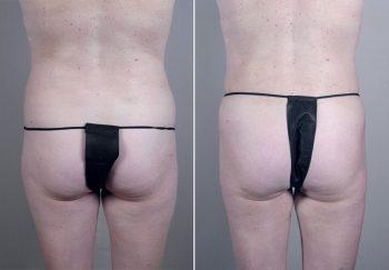 Mommy Makeover Patient 22