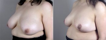 Breast Lift (Vertical Mastopexy Only) Patient 10