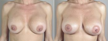 Removal & Replacement of Implants Patient 15