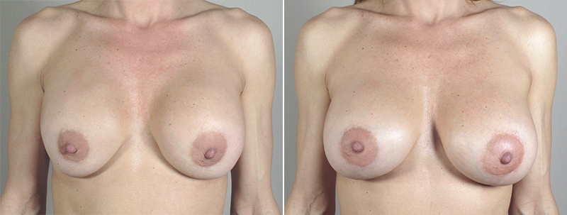 Removal & Replacement of Implants Patient 15