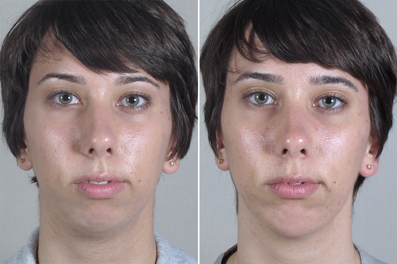 Chin Implant Patient 11