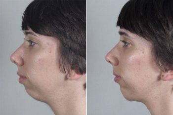 Chin Implant Patient 11