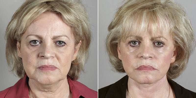 Face Lift Patient 19