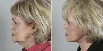 Face Lift Patient 19