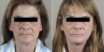 Face Lift Patient 20