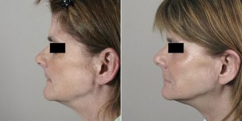 Face Lift Patient 20