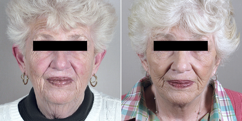 Face Lift Patient 21