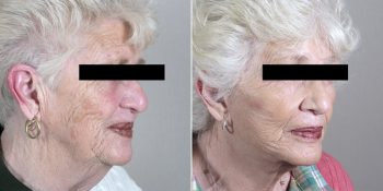 Face Lift Patient 21