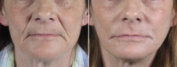 Face Lift Patient 20
