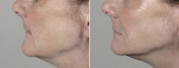 Face Lift Patient 20