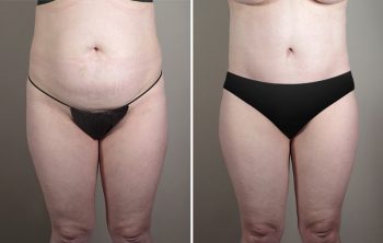 Skin Cancer Treatment Patient 29