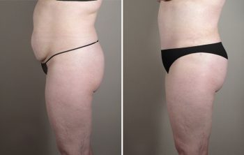 Skin Cancer Treatment Patient 29