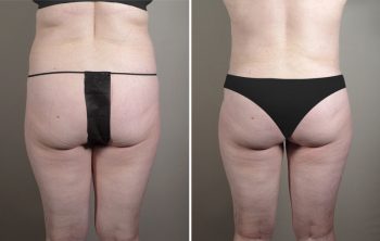 Skin Cancer Treatment Patient 29