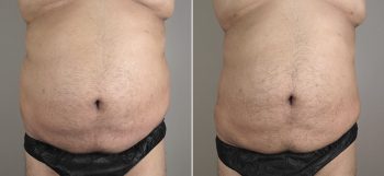 Male Liposuction Patient 18