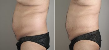 Male Liposuction Patient 18